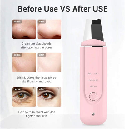 Xiaomi inFace Ion Ultrasonic Skin Scrubber Blackhead Remover